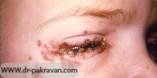 كونژنكتيويت‌های ناشی از تبخال همراه با زخم و دمل پوست اطراف چشم